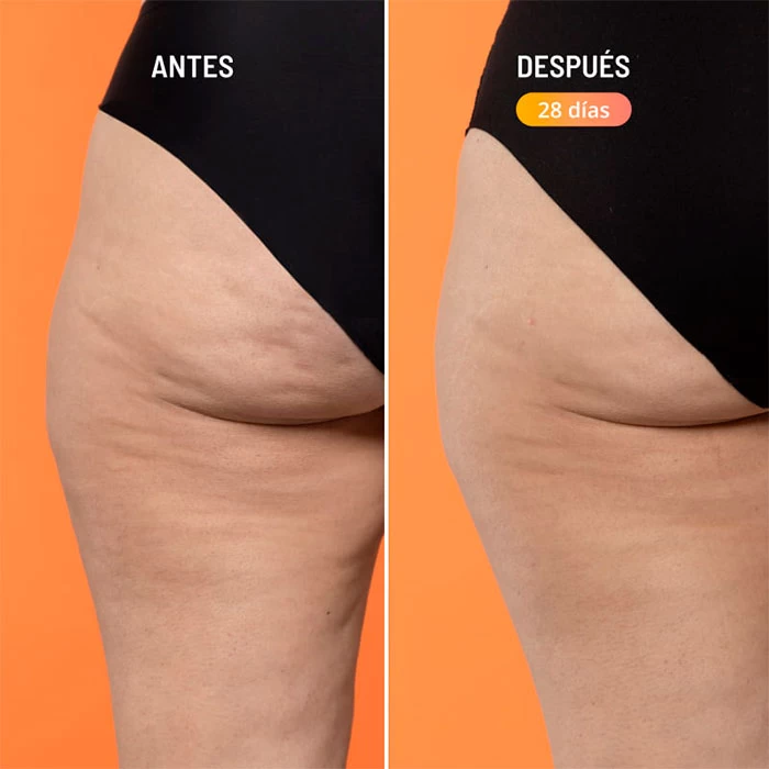 Beta-Burner Sculpting Treatment 4 Beta-Burner Sculpting Treatment - Imagen 2